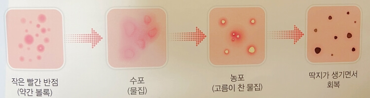 대상포진 전염성 및 증상 - 백점생활지식